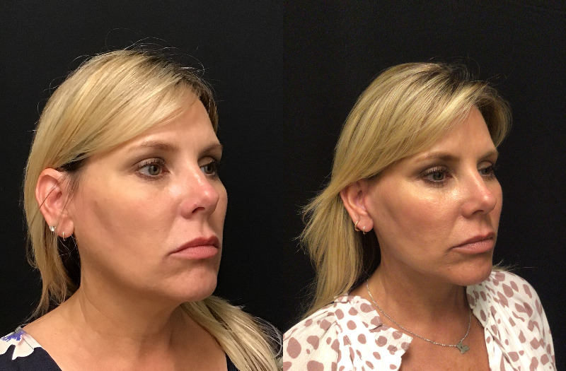 before and after neck lift