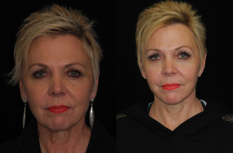before and after neck lift