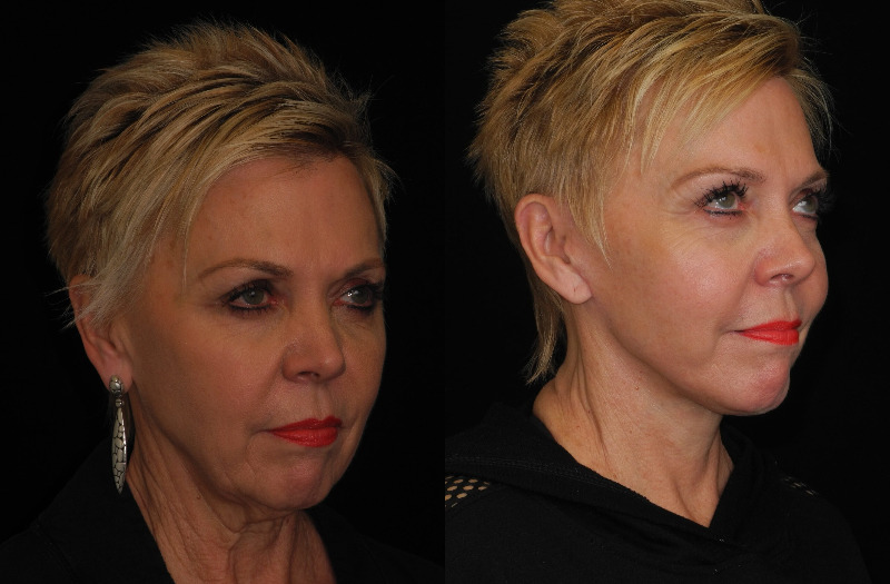 before and after neck lift