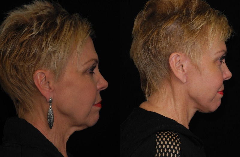 before and after neck lift