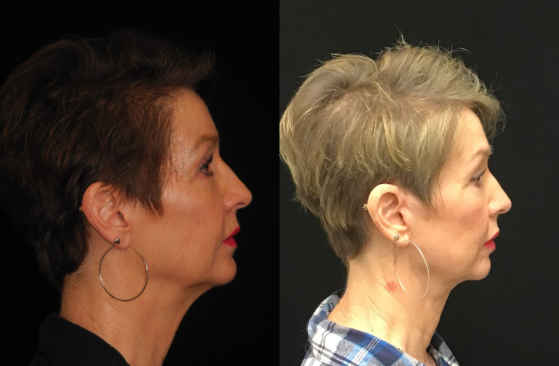 before and after neck lift