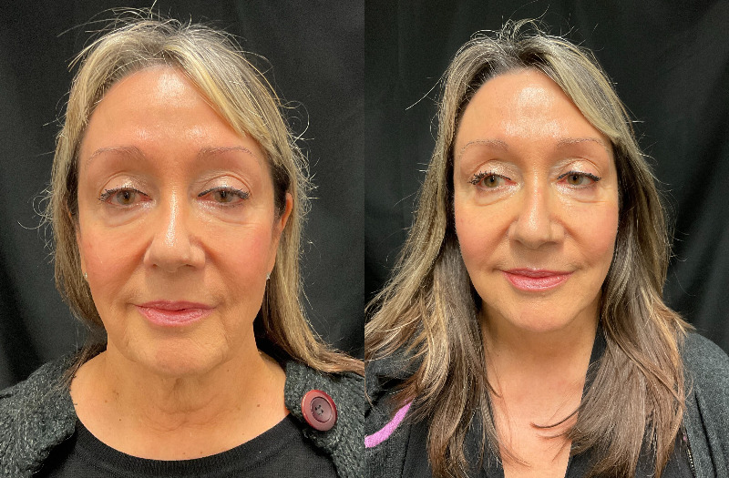 before and after neck lift