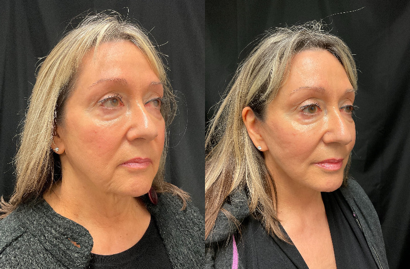 before and after neck lift