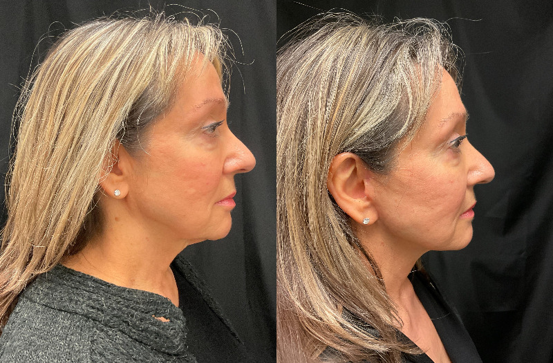 before and after neck lift