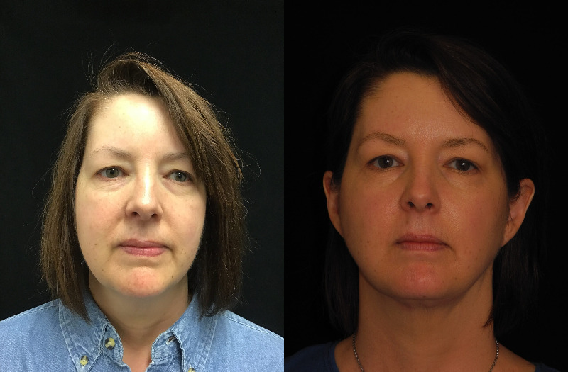 before and after neck lift