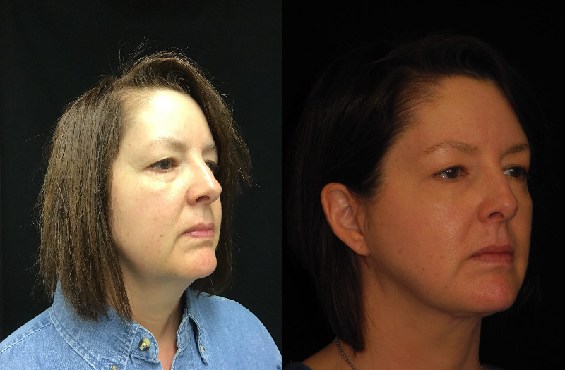 before and after neck lift