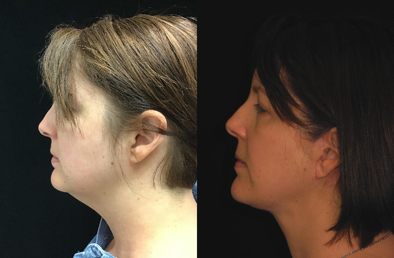 before and after neck lift