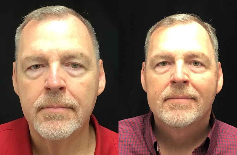 before and after neck lift