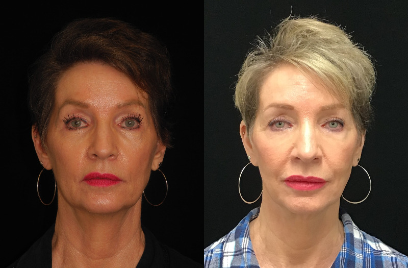 before and after neck lift