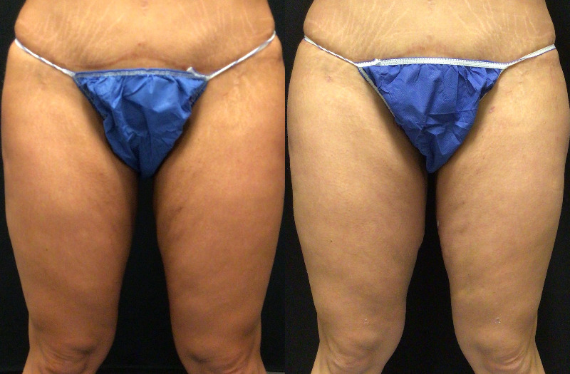 before and after thigh lift