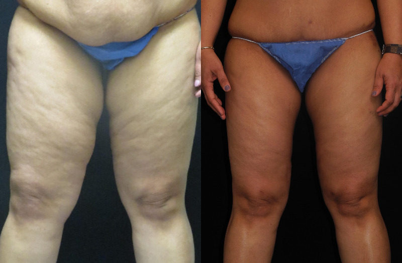 before and after thigh lift