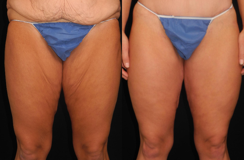 before and after thigh lift