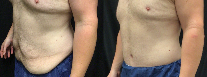 before and after tummy tuck