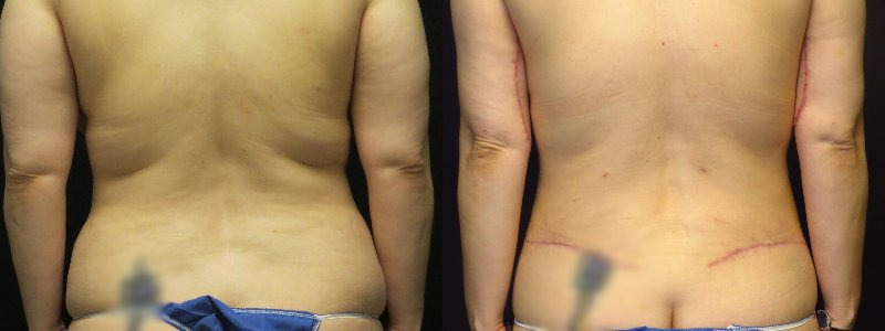 before and after tummy tuck