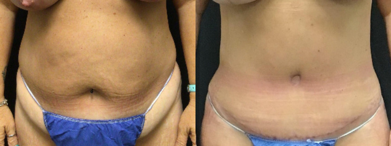 before and after tummy tuck