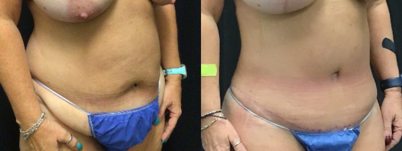 before and after tummy tuck