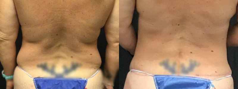 before and after tummy tuck