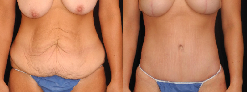 before and after tummy tuck