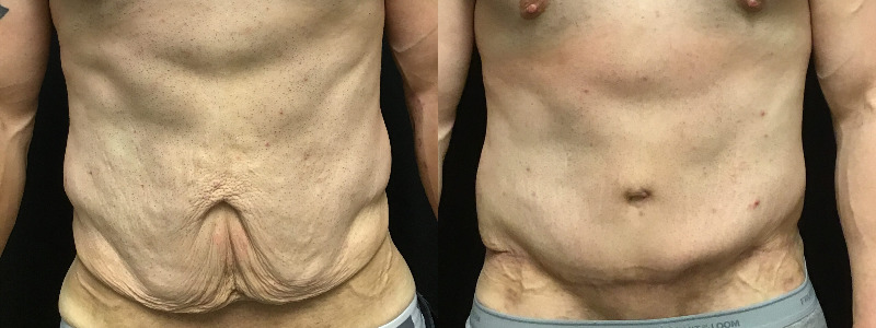 before and after tummy tuck
