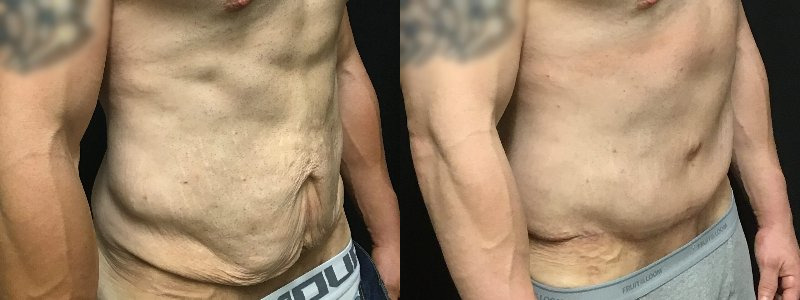 before and after tummy tuck