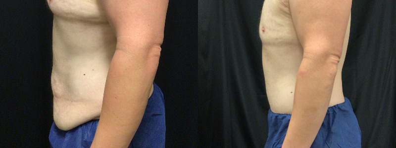 before and after tummy tuck