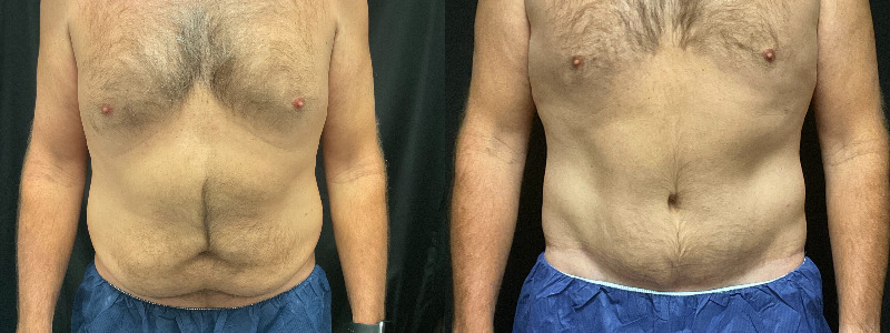 before and after tummy tuck