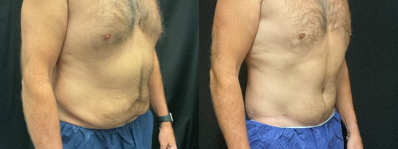 before and after tummy tuck