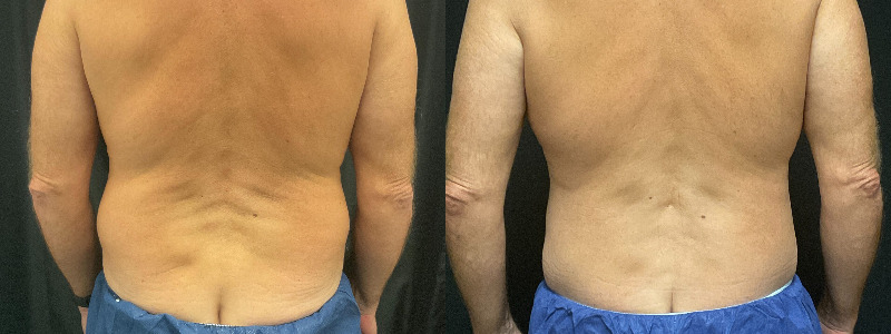 before and after tummy tuck
