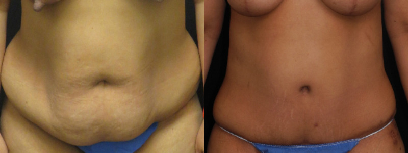 before and after tummy tuck