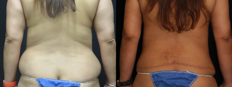 before and after tummy tuck