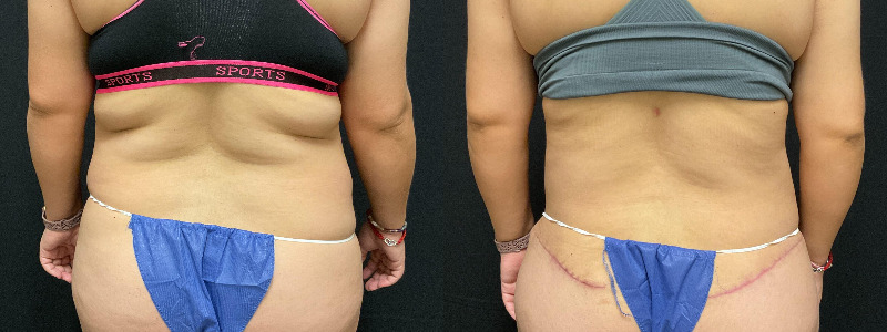 before and after tummy tuck