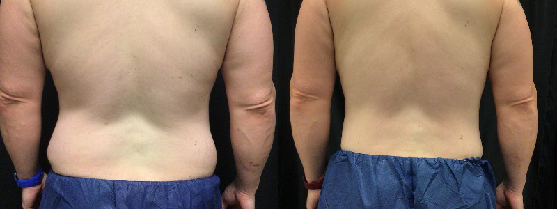 before and after tummy tuck