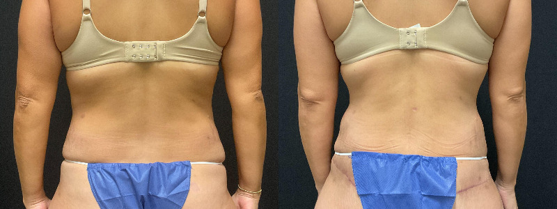 before and after tummy tuck