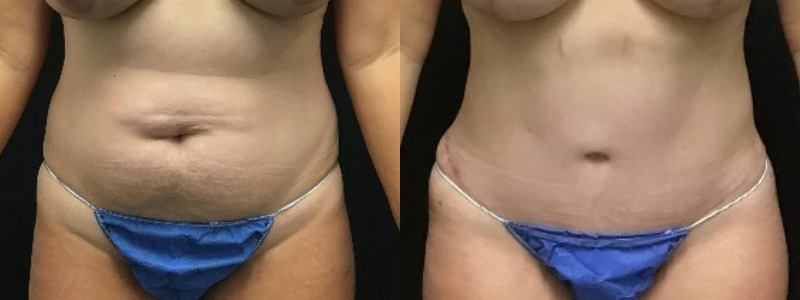 before and after tummy tuck