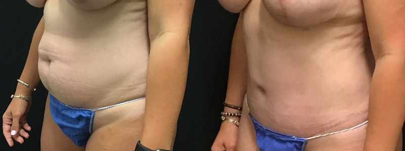 before and after tummy tuck