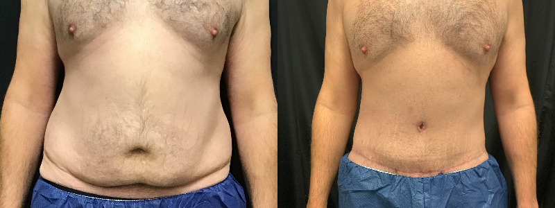 before and after tummy tuck