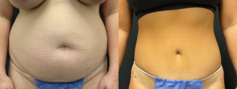before and after tummy tuck