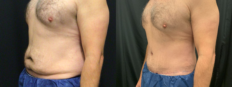 before and after tummy tuck