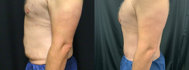 before and after tummy tuck