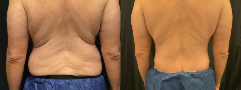 before and after tummy tuck