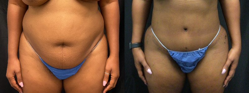 before and after tummy tuck