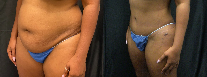 before and after tummy tuck