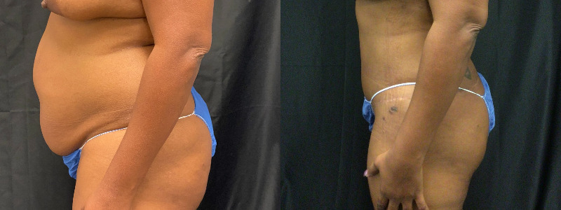 before and after tummy tuck