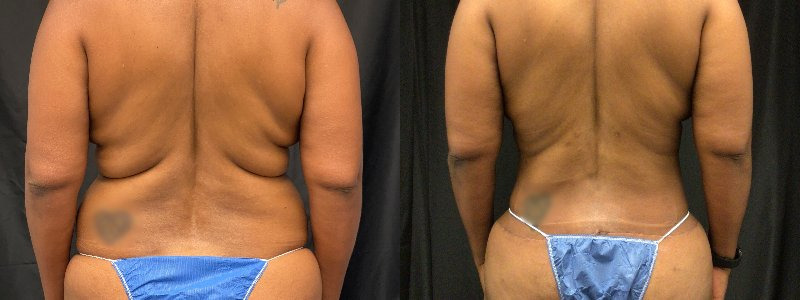 before and after tummy tuck