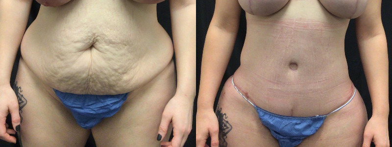before and after tummy tuck