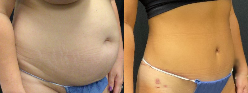 before and after tummy tuck