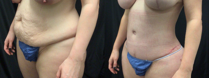 before and after tummy tuck