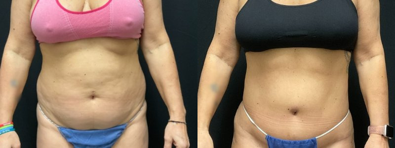 before and after tummy tuck