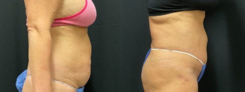 before and after tummy tuck