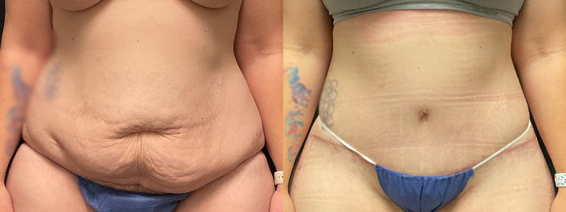 before and after tummy tuck
